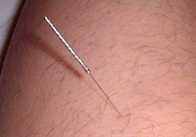 Accupuncture needle