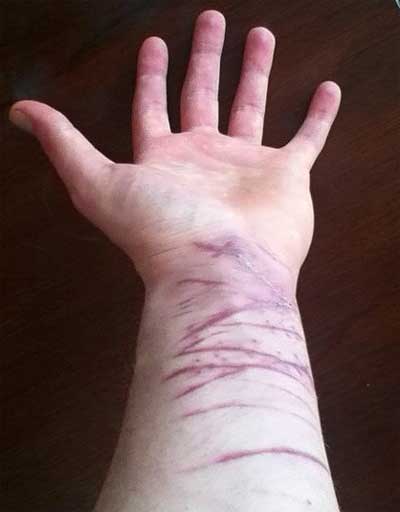 cuts to the wrist are a cry for help.