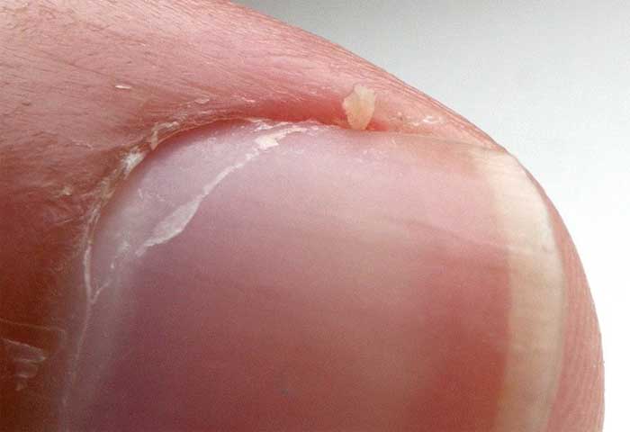 dry fingernail with a hang nail
