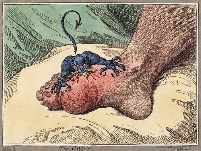 Drawing of foot with painful gout condition