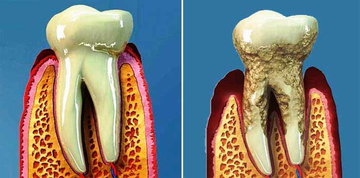 Illustration shows progression of gum disease