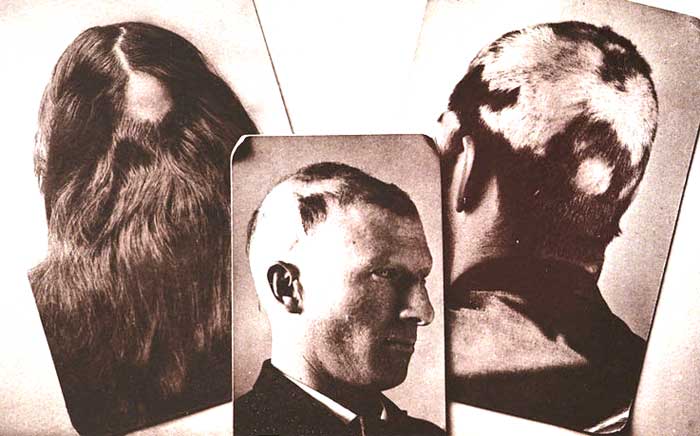 examples of pattern baldness