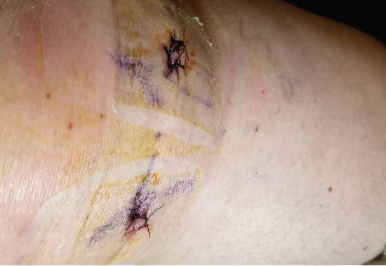 knee incisions after minescus surgery
