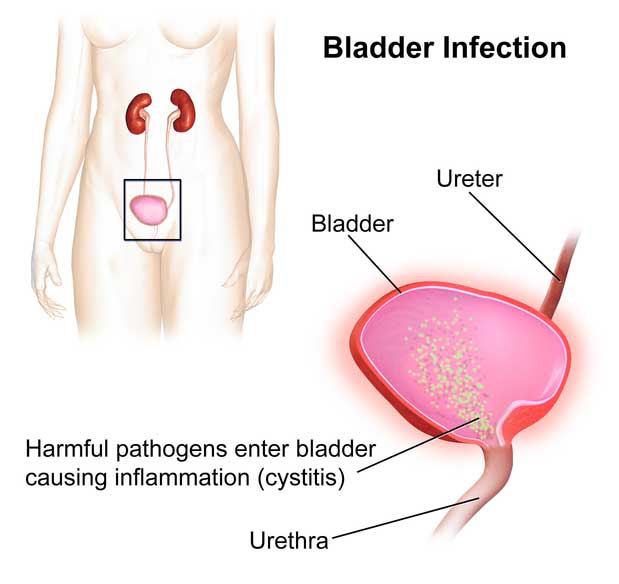 Bladder infection diagram