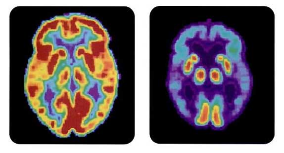 PET scan of normal and diseased brain