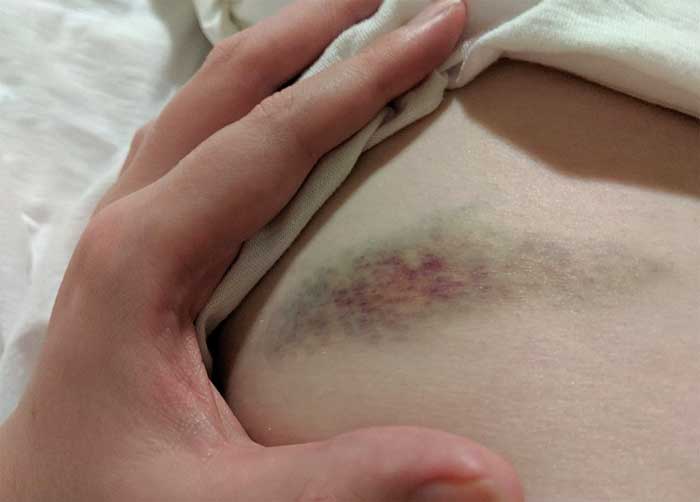 Large bruise on the abdomen