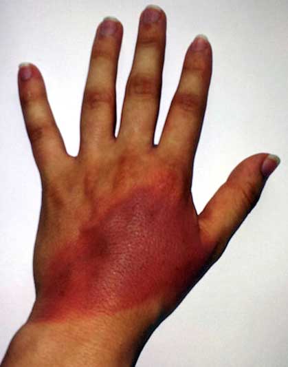 Hand with 2nd degree burn