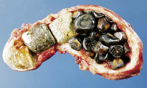 Gallbladder full of stones