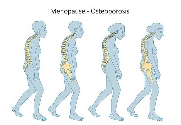 Stages of menopausal osteoporosis