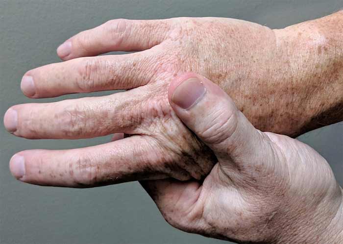 Hands with arthritis pain