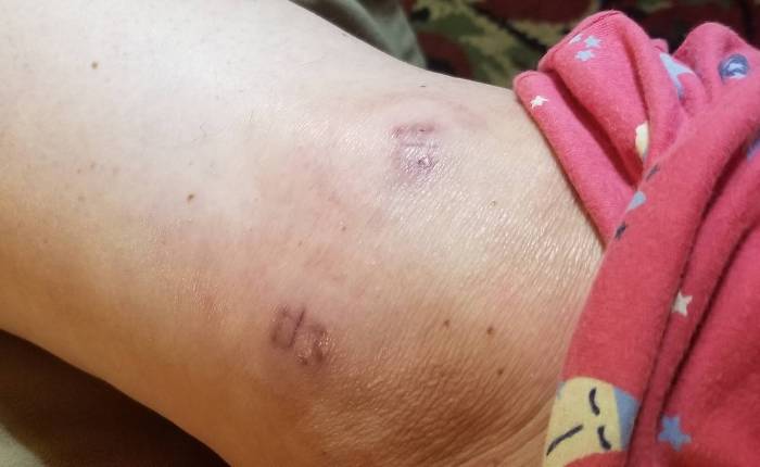 Knee incision after 14 days
