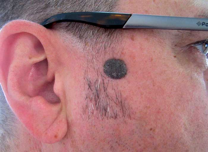 man with a mole on his face