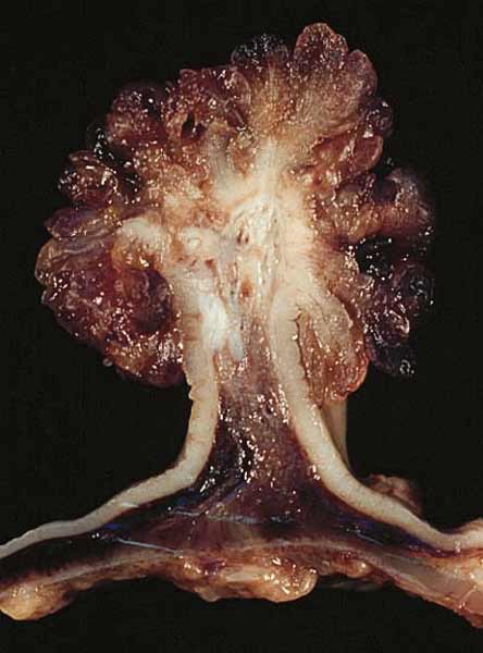 Polyp in the colon