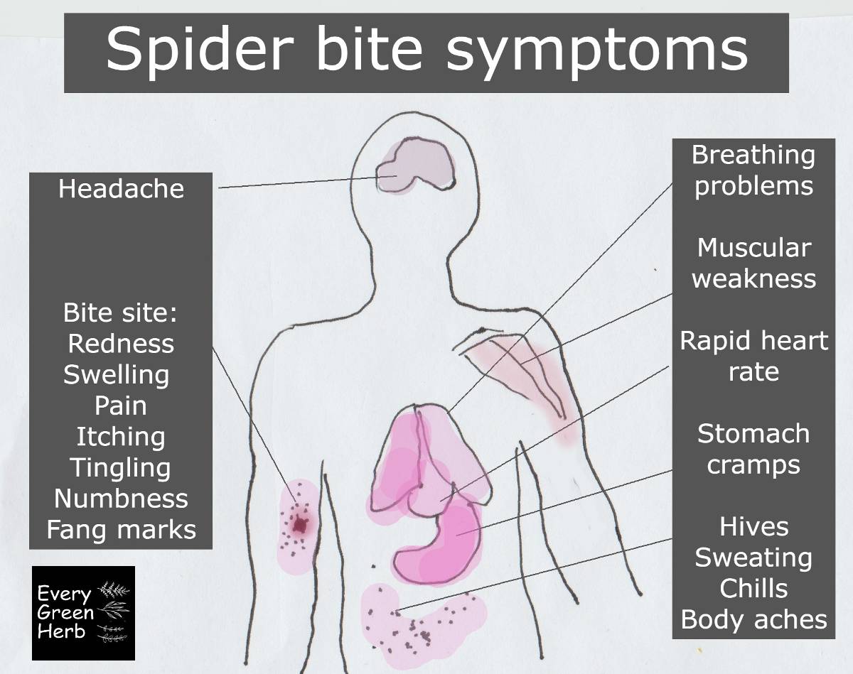 Graphic shows symptoms of a spider bite