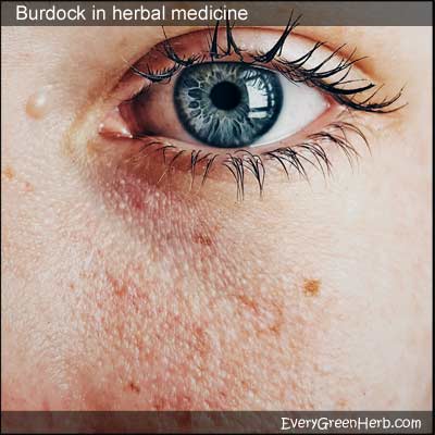 Burdock root tea can heal eczema.